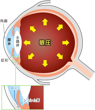 緑内障とは